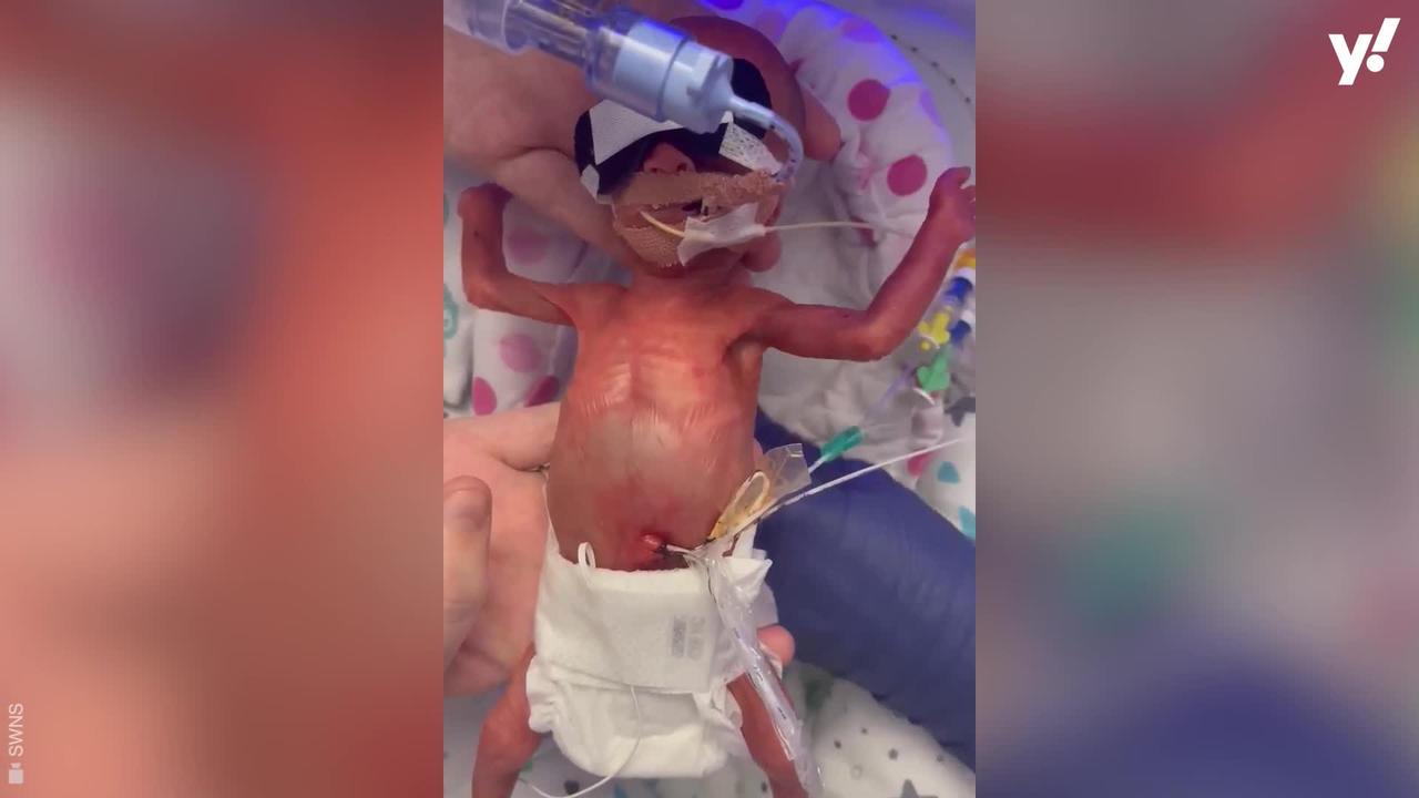 Teenage mum gives birth to newborn believed to be the UK's smallest premature baby