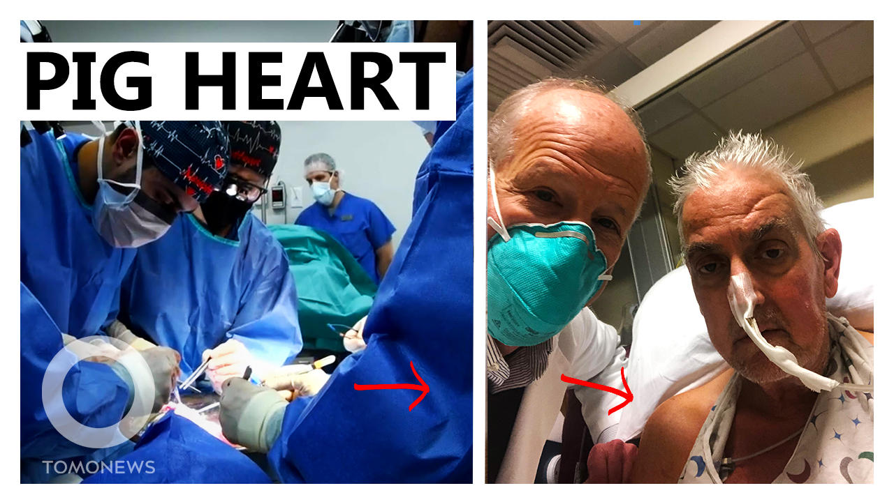 World’s First Pig-to-Human Heart Transplant: Surgeons Attached a Pig Heart to a Human