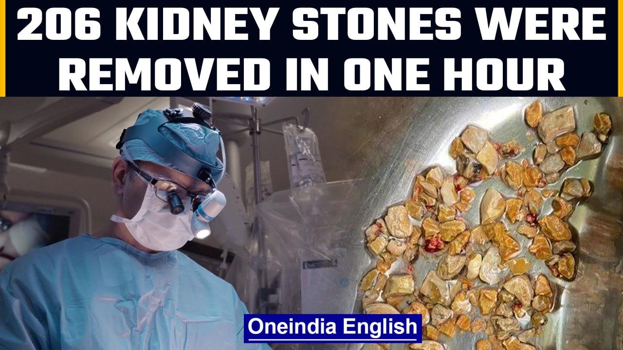 206 kidney stones removed from 56-year-old man in Hyderabad | Oneindia News