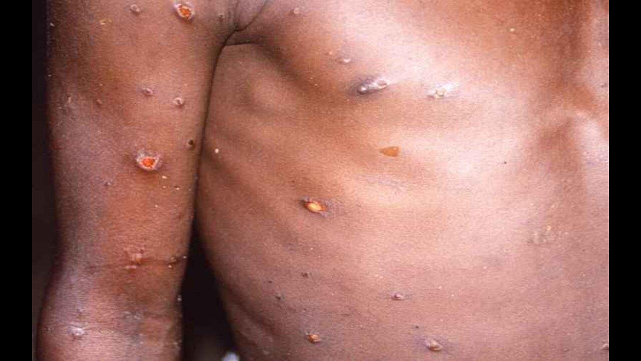 WHO Confirms 131 Worldwide Cases of Monkeypox, Says Outbreak Is 'Containable'