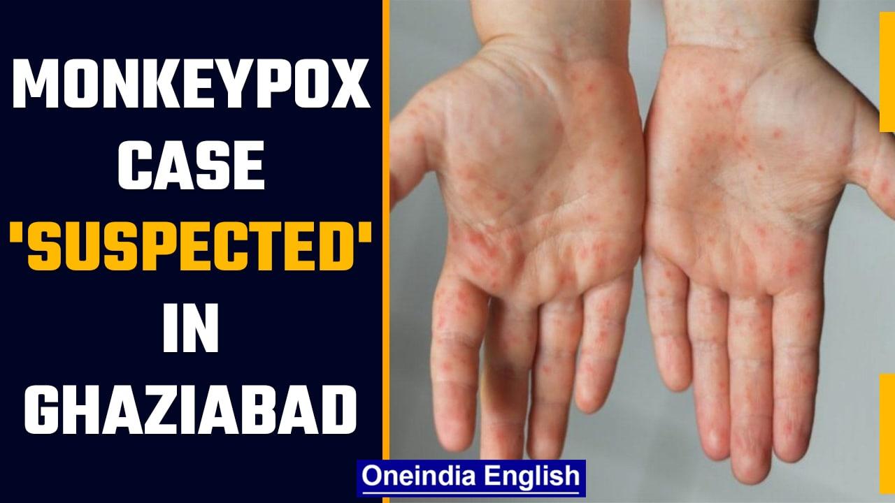 Monkeypox-like symptoms suspected in a Ghaziabad girl, health officials alerted | OneIndia News