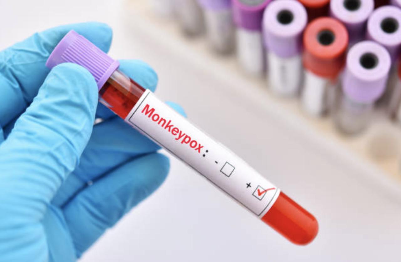 CDC Ramps Up Monkeypox Alert to Level 2