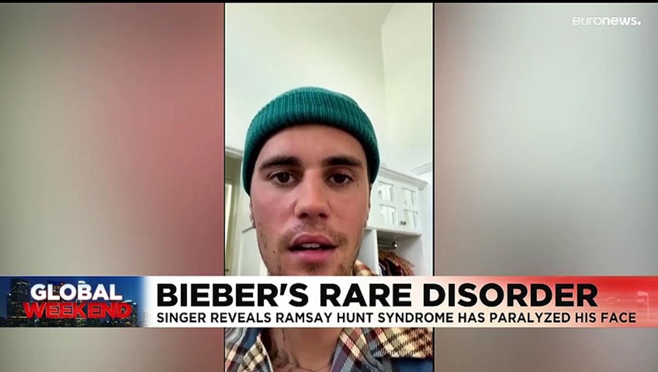Justin Bieber reveals a rare disorder has paralysed half of his face