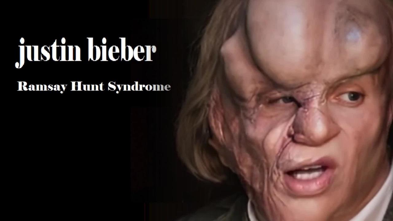 JUSTIN BIEBER - MILD CASE OF RAMSAY HUNT SYNDROME .... NOTHING TO SEE HERE !