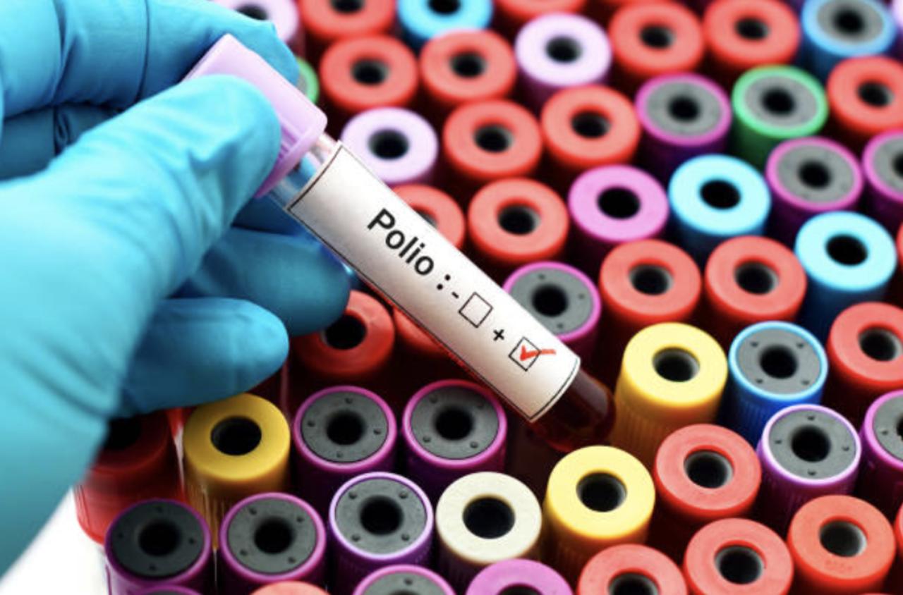 Polio Virus Is Detected in London Sewage Sample