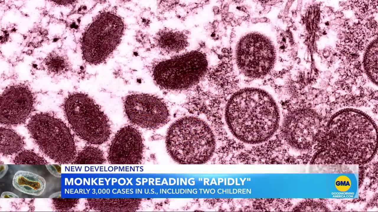 WHO calls monkeypox outbreak a 'public health emergency' l GMA