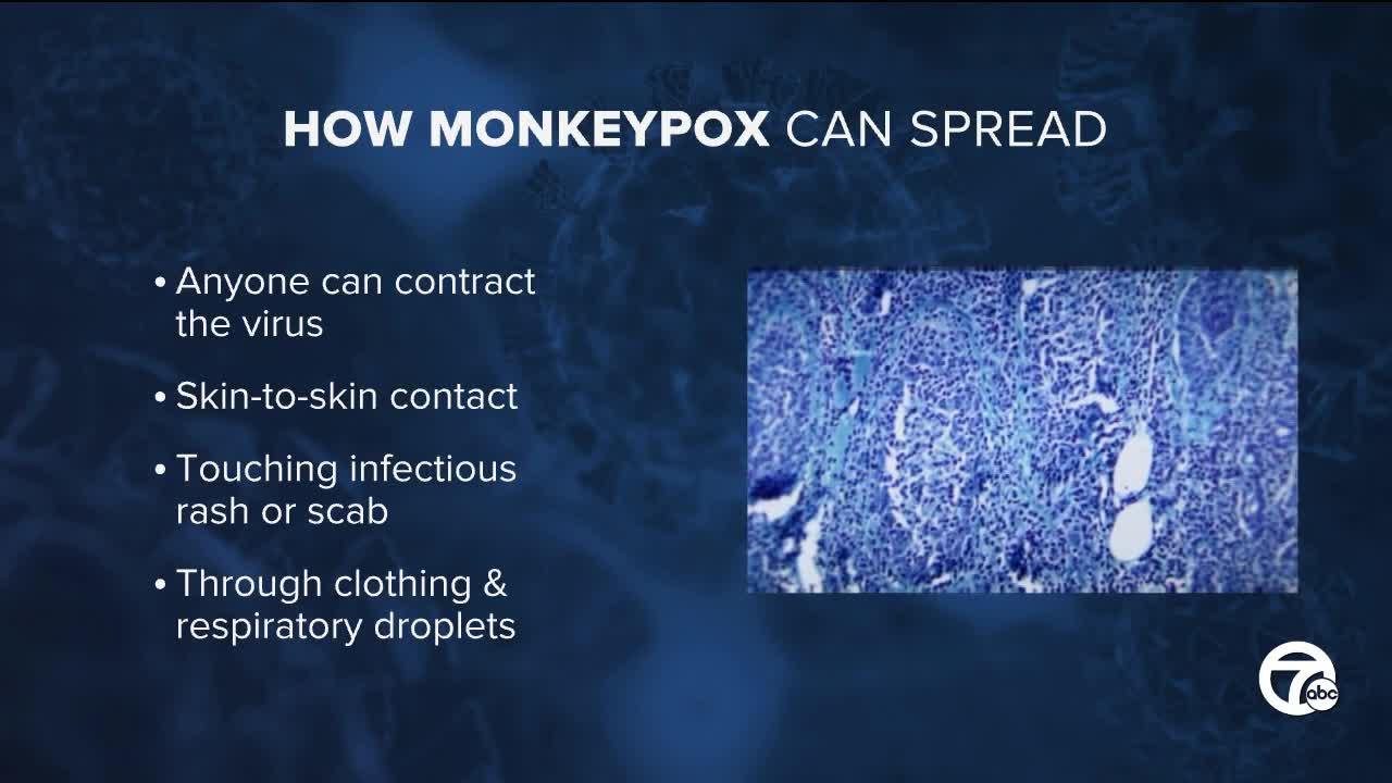 WHO declares monkeypox global health emergency and how Michigan is preparing