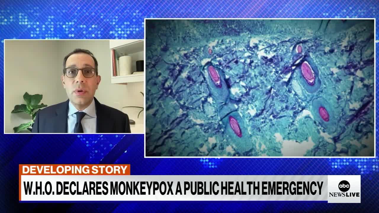 San Francisco declares public health emergency for monkeypox