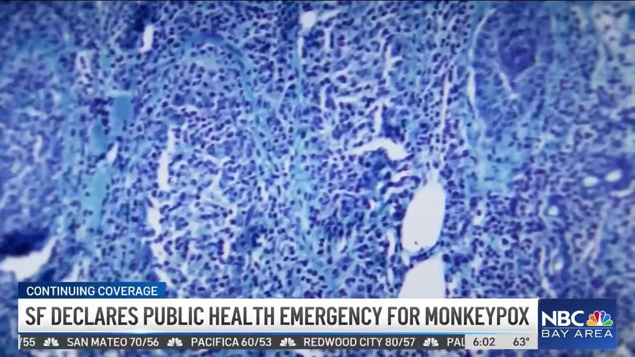 San Francisco Declares Public Health Emergency for Monkeypox