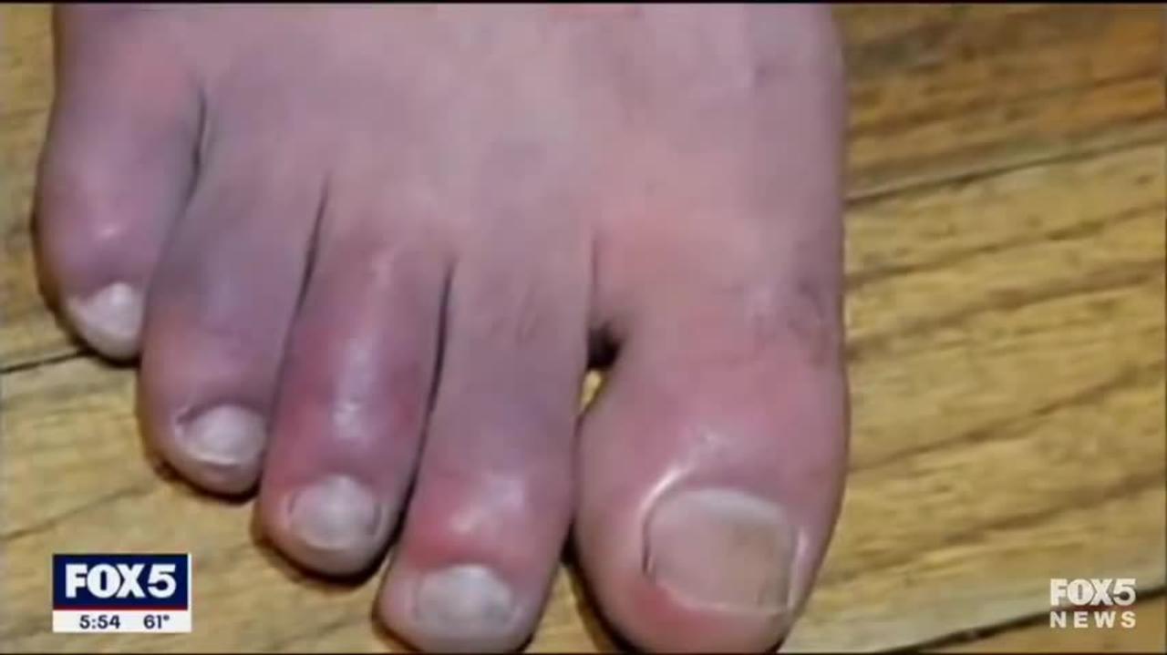VAERS: 28 YR OLD MAN DEVELOPS "COVID TOE" AFTER EVERY SHOT? C'MON....