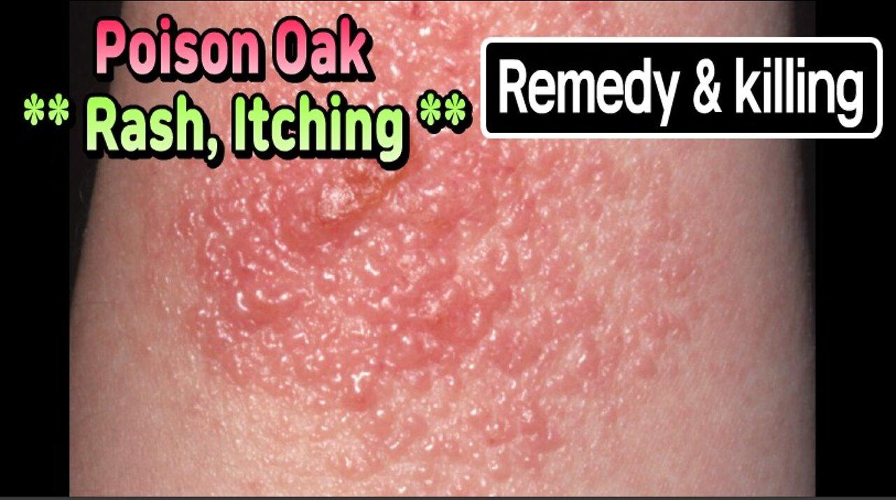 Poison Oak rash, itching, remedy and killing. - One News Page VIDEO