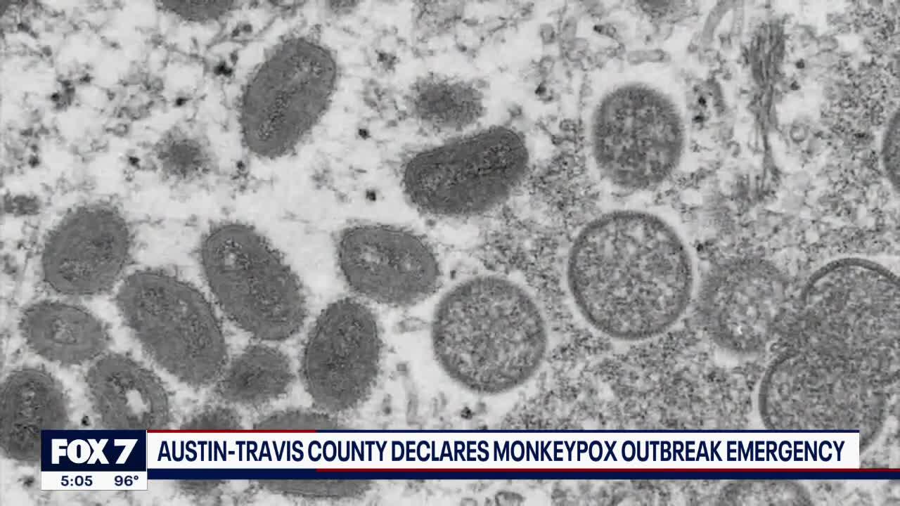 Austin-Travis County declares monkeypox outbreak emergency