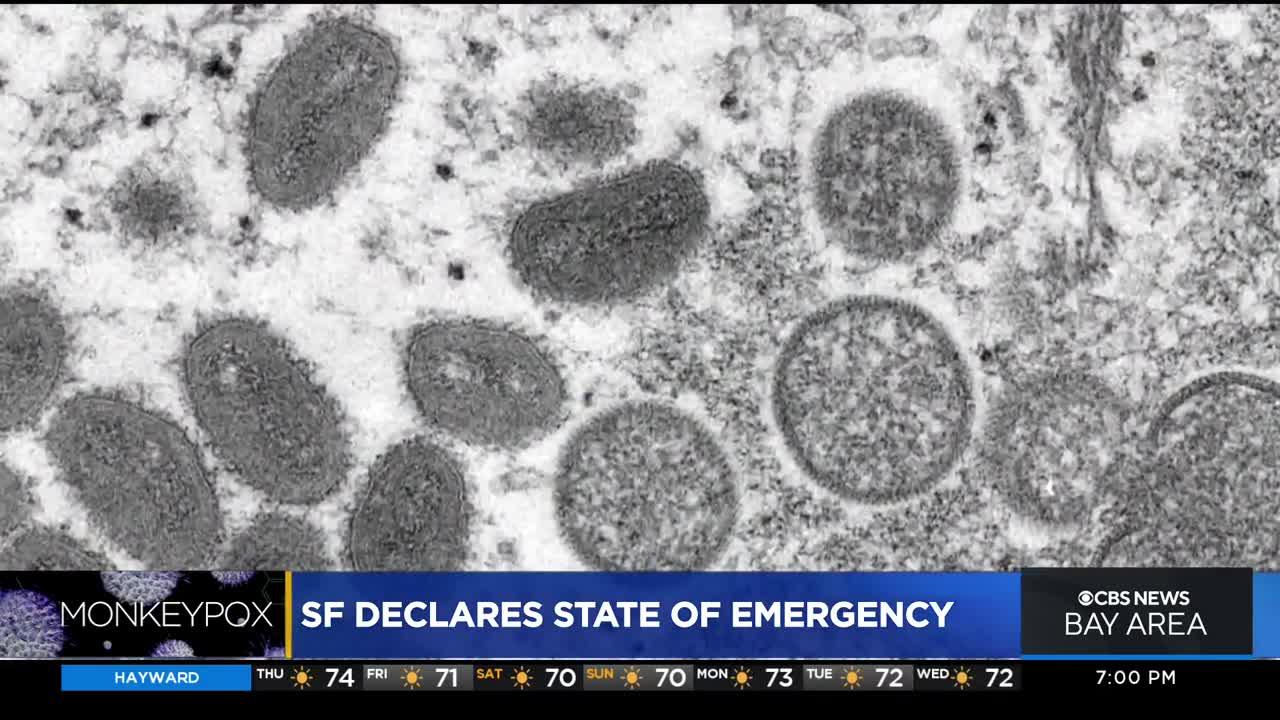 San Francisco declares public health emergency due to monkeypox