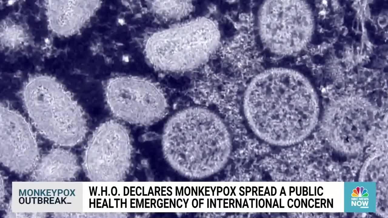 Should You Be Concerned After WHO Declares Monkeypox A Public Health Emergency?