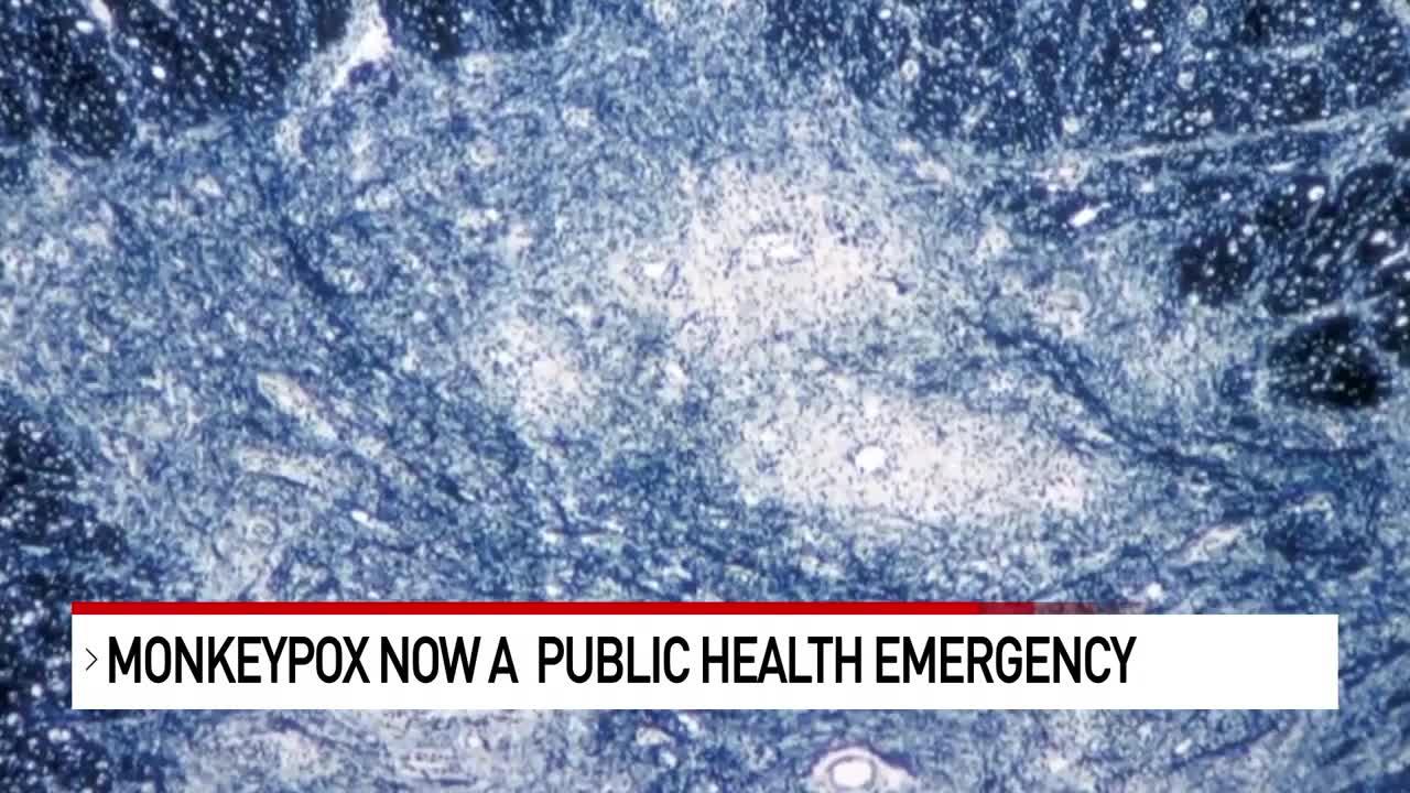 Scientists, healthcare providers prepare next steps in monkeypox public health emergency