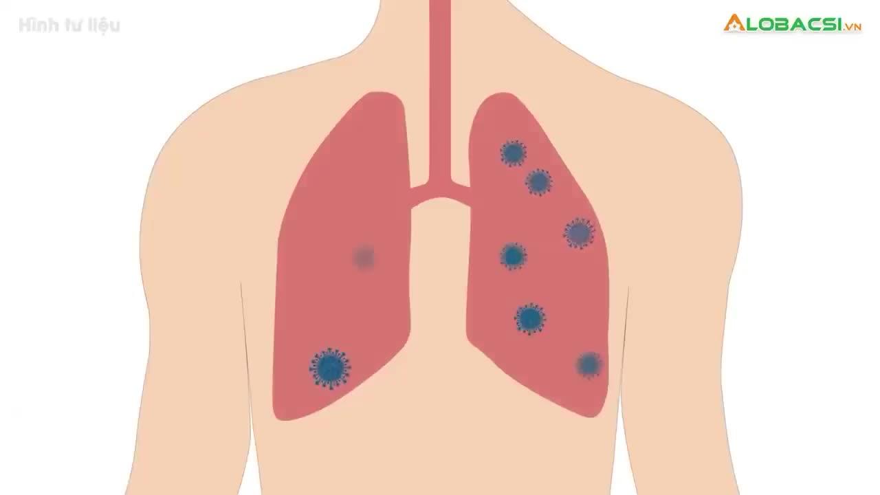 Nguy cơ thuyên tắc phổi tăng 33 lần ở bệnh nhân hậu vac, dấu hiệu nào nhận diện?