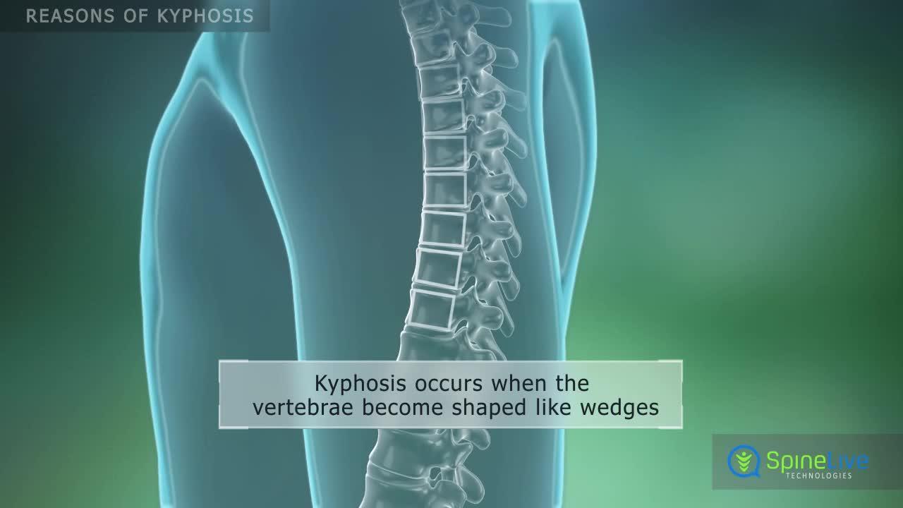 Kyphosis Reasons