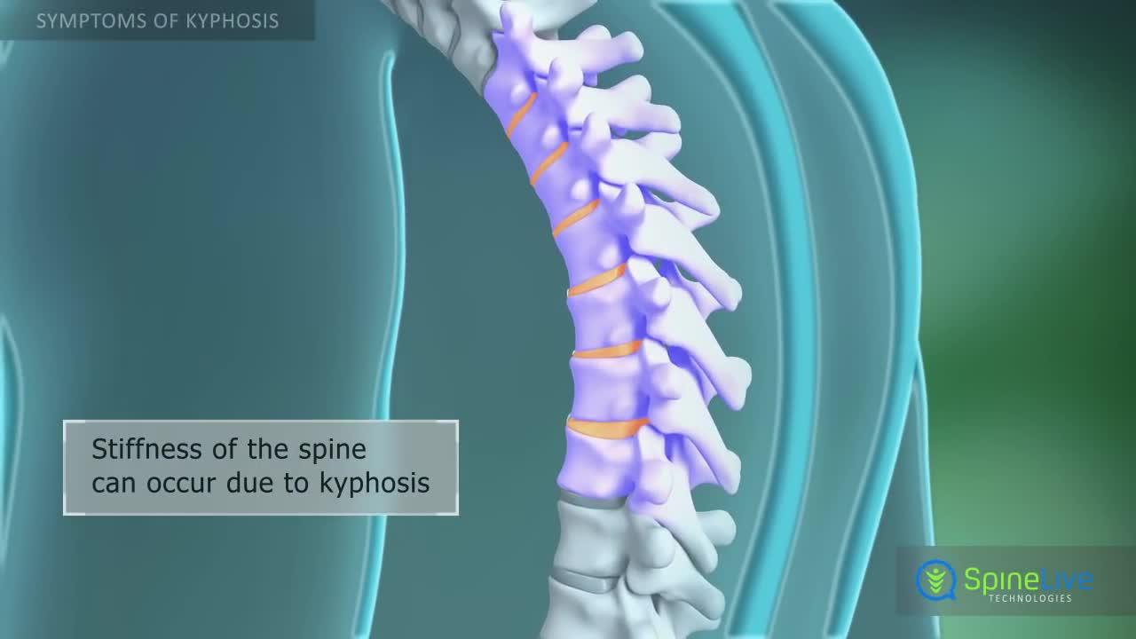 Kyphosis Symptoms