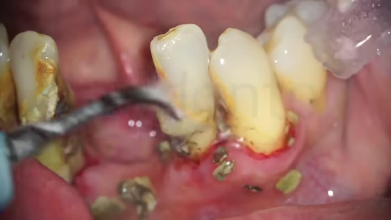 Scaling and root planing with sonic instruments One News Page VIDEO