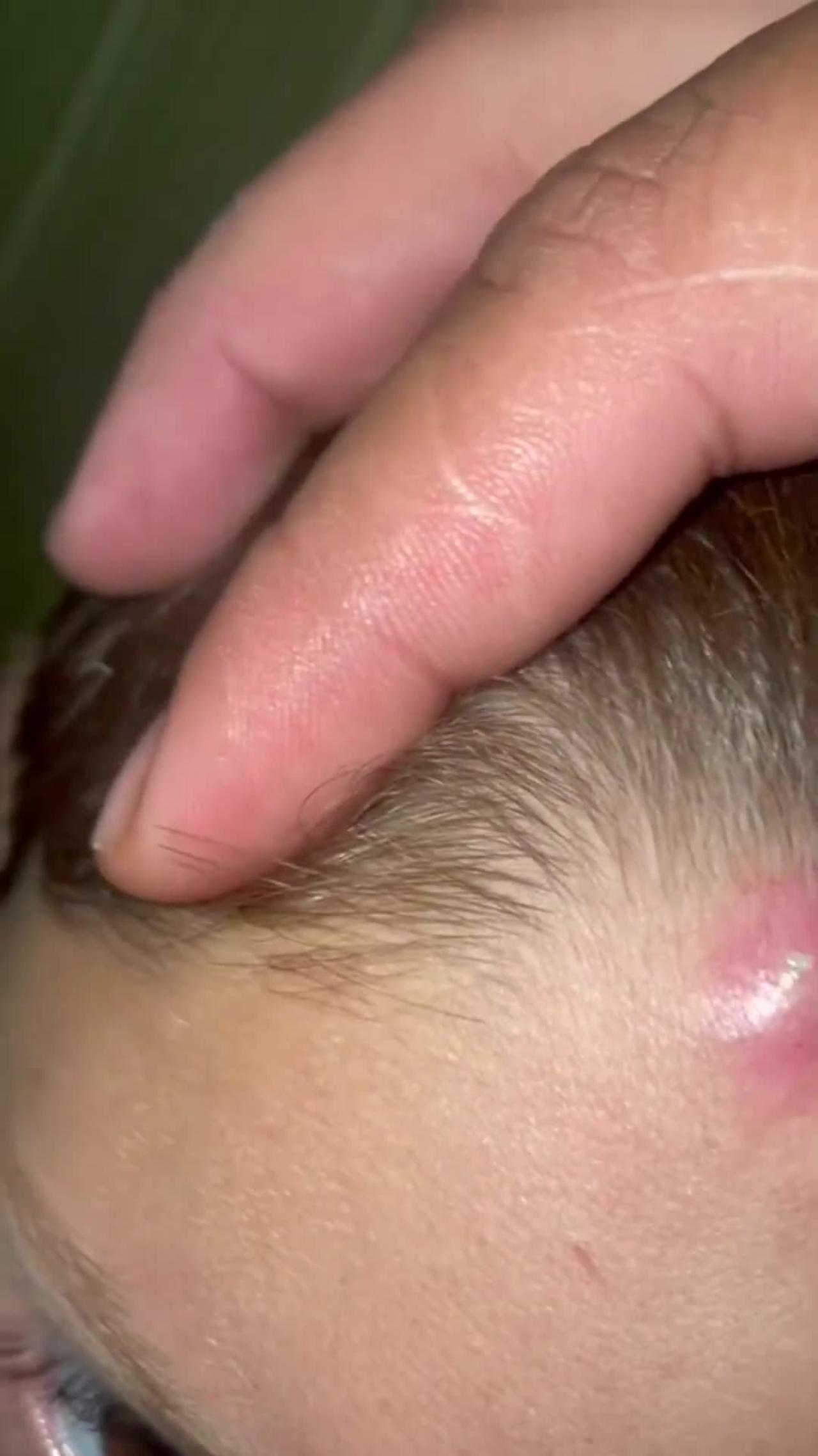 You'll love this #pimple  #extraction  #popping  #skincare  #cyst  #whiteheads  #blackheads