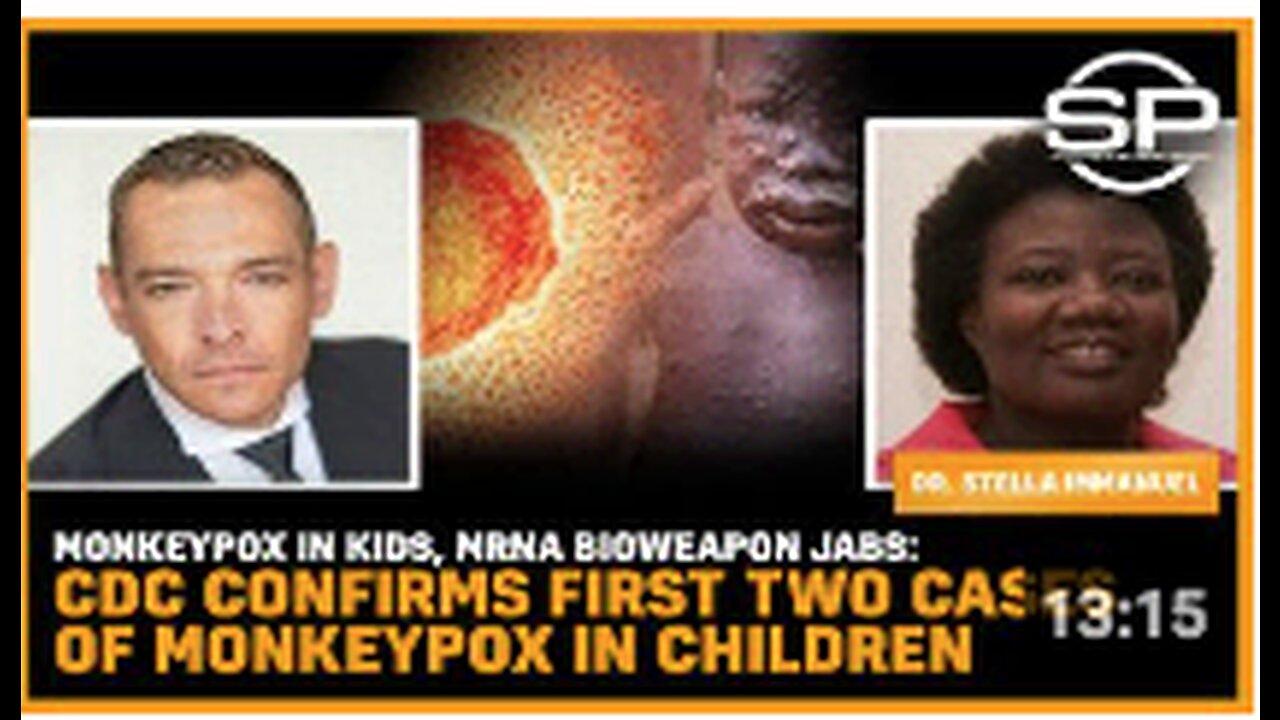 Monkeypox In Kids, mRNA Bioweapon Jabs: CDC Confirms First Two Cases Of Monkeypox In Children
