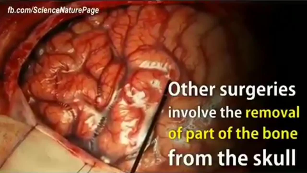 Brain tumor surgery