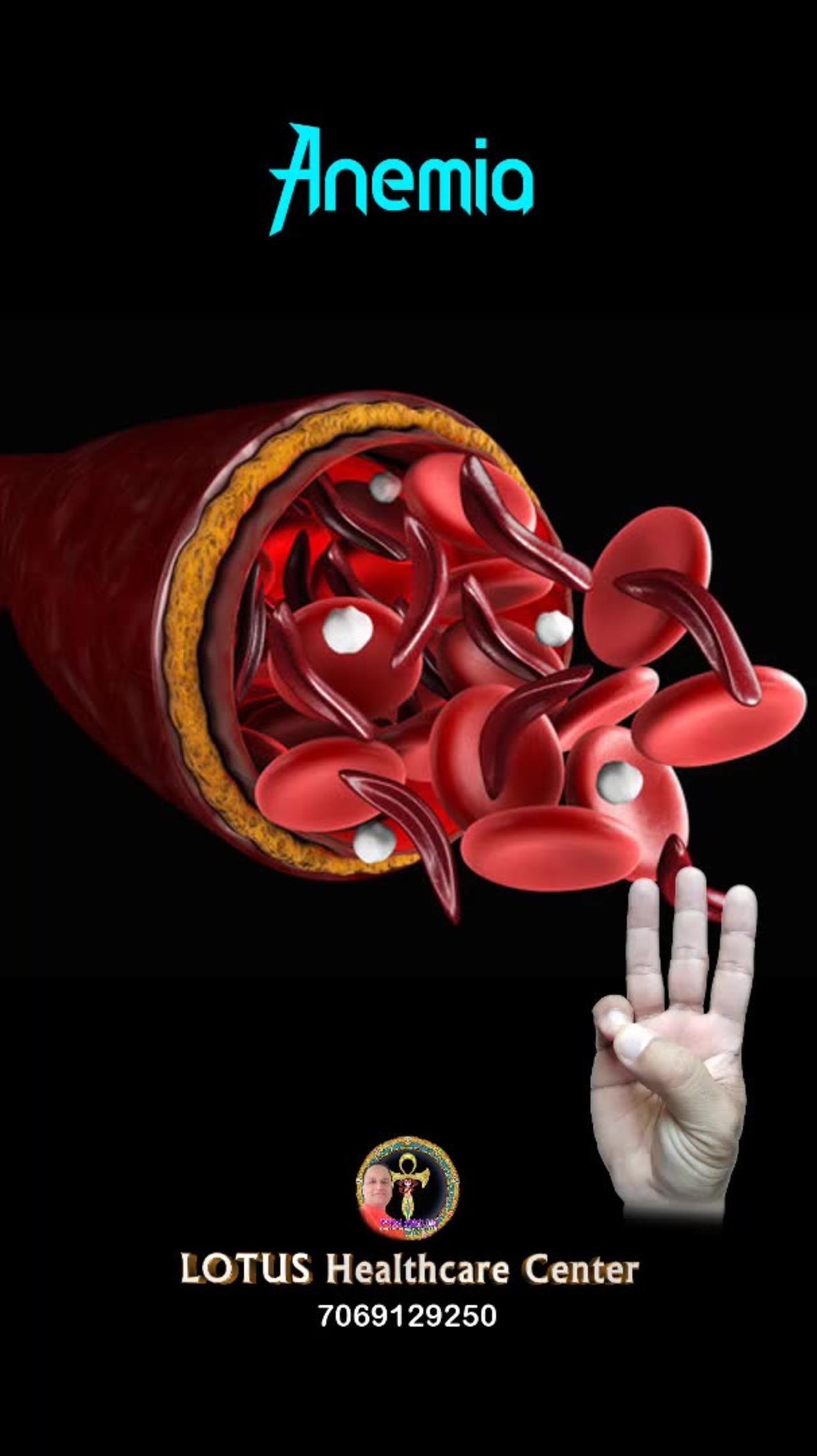 How to treat anemia problem by ancient hast one news page video
