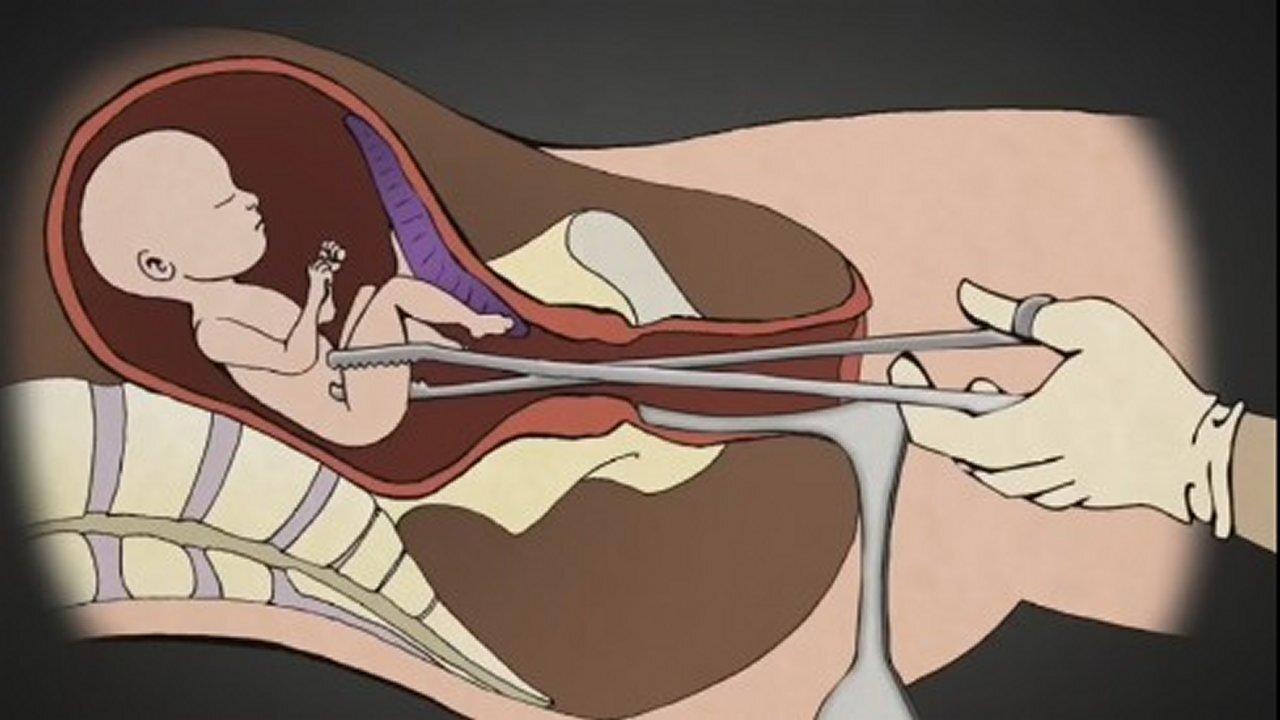 Here’s how an 'Abortion' Works!  Planned Parenthood, Fetal Organs, Adrenochrome! [30.05.2023