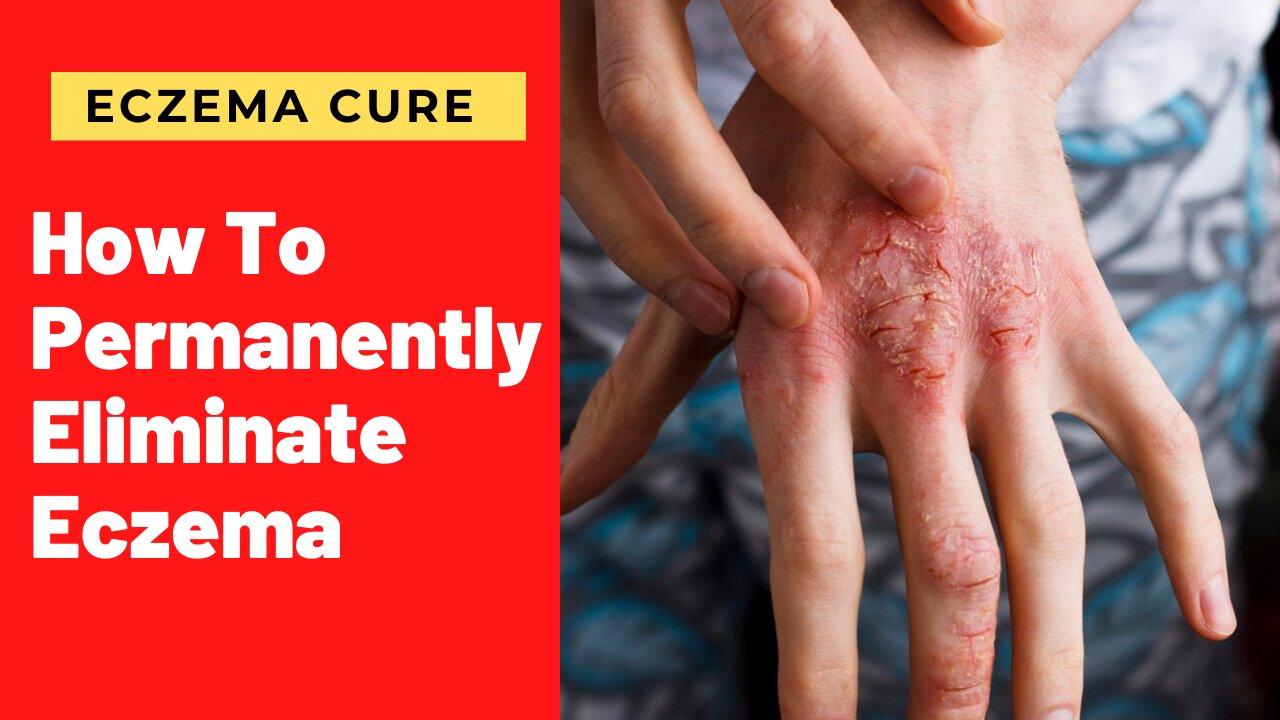 how to cure eczema easily naturally and forever One News Page VIDEO
