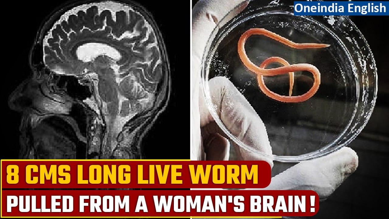 Australia: 8-cms long, 1-mm wide alive, wriggling parasitic worm found in a woman's brain