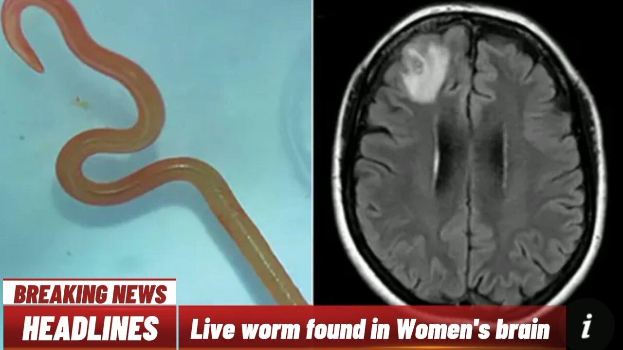 Live worm is found in Australian women's brain | WorldMedia|