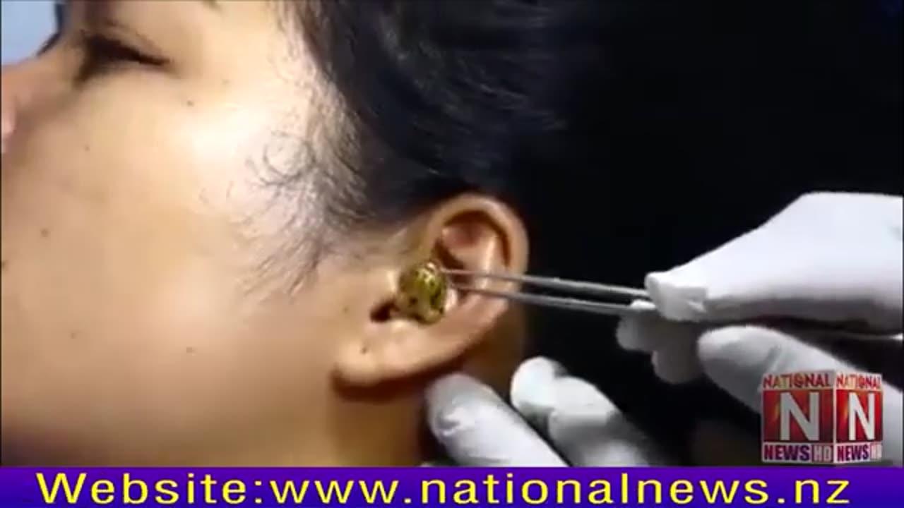 A Much Watchv ideo of a snake coming out of a woman's ear has gone viral