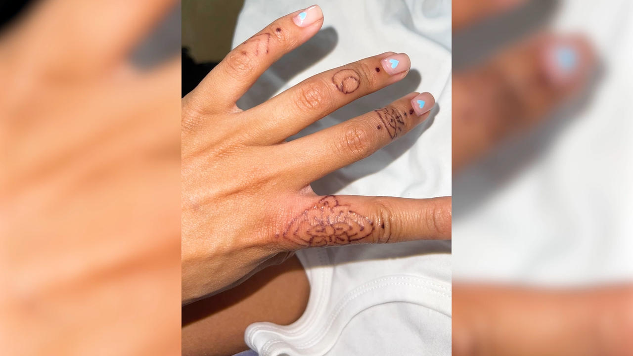 ‘A henna tattoo on holiday left my hands scarred for two years’