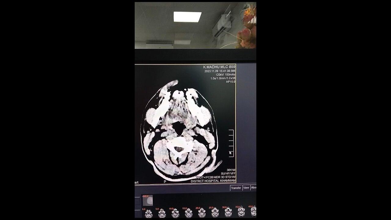 ct scan brain