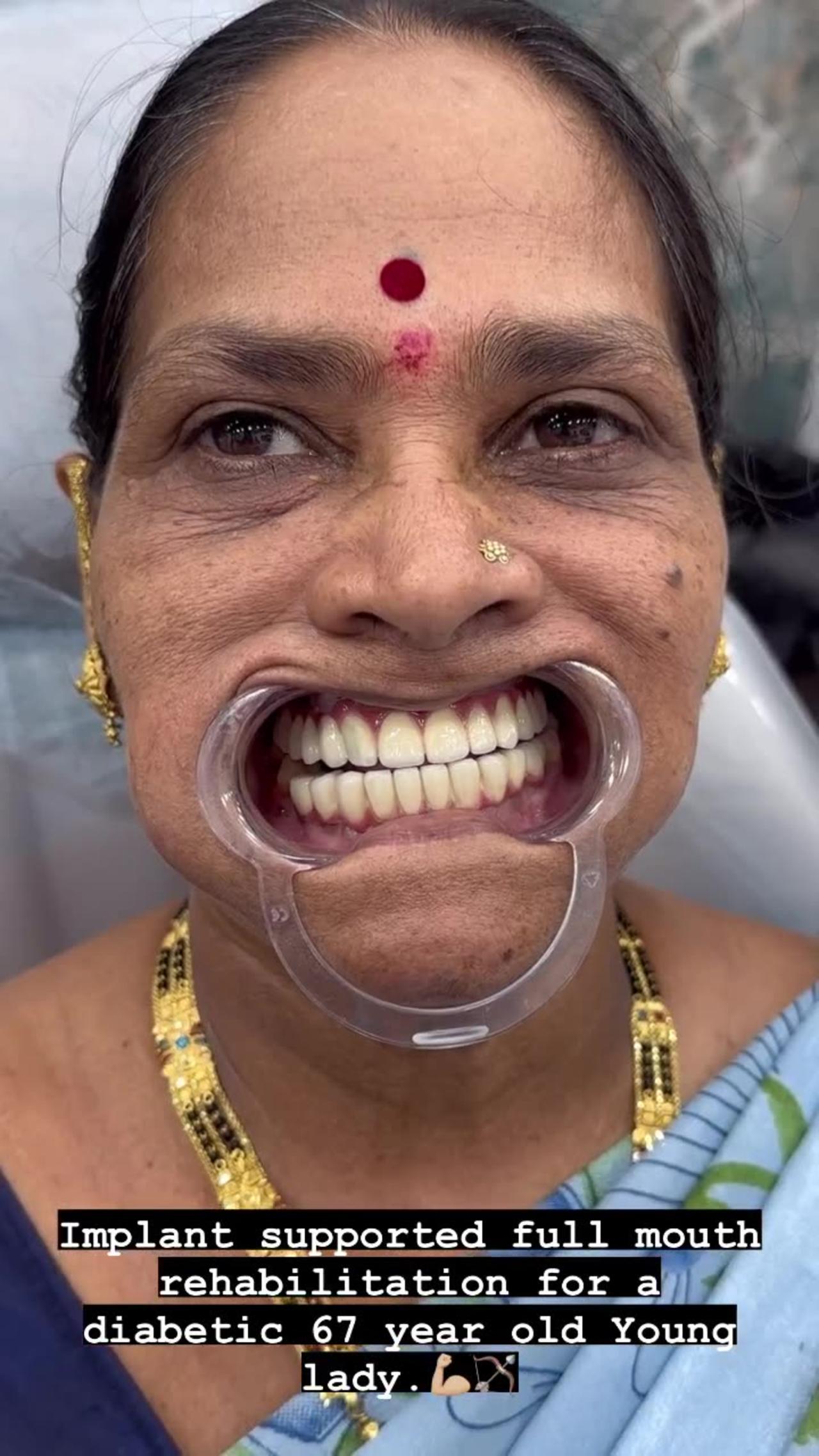 Full Mouth Dental Implants in Navi Mumbai
