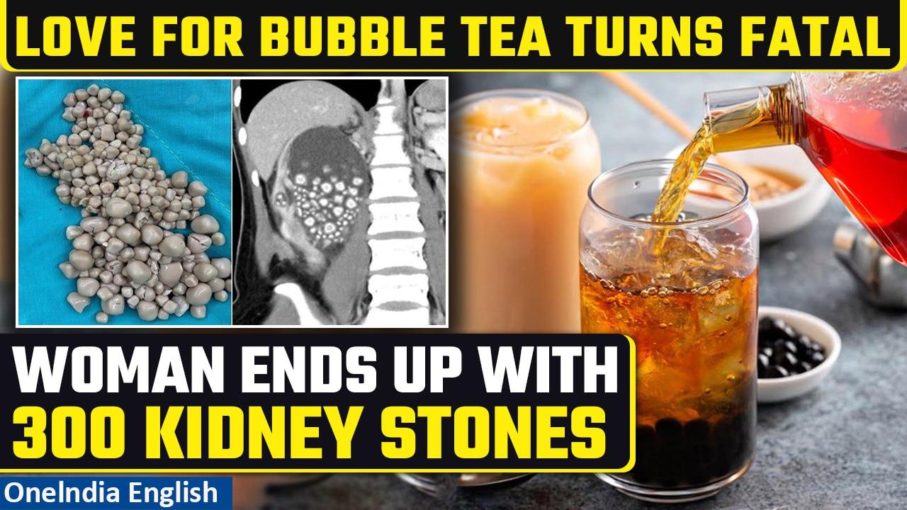 Taiwan woman replaces drinking water with bubble tea, ends up with 300 kidney stones | Oneindia News