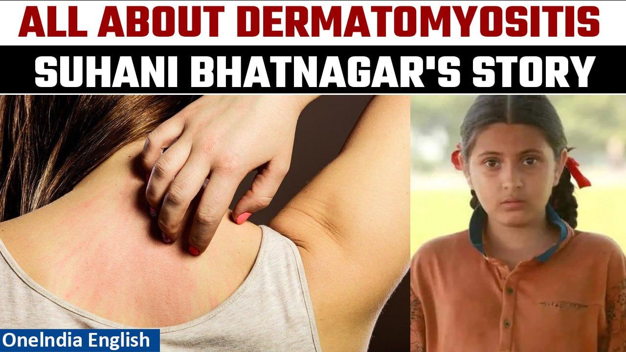 Dermatomyositis: All About the Cause of 'Dangal' Actor Suhani Bhatnagar's Demise | Oneindia News