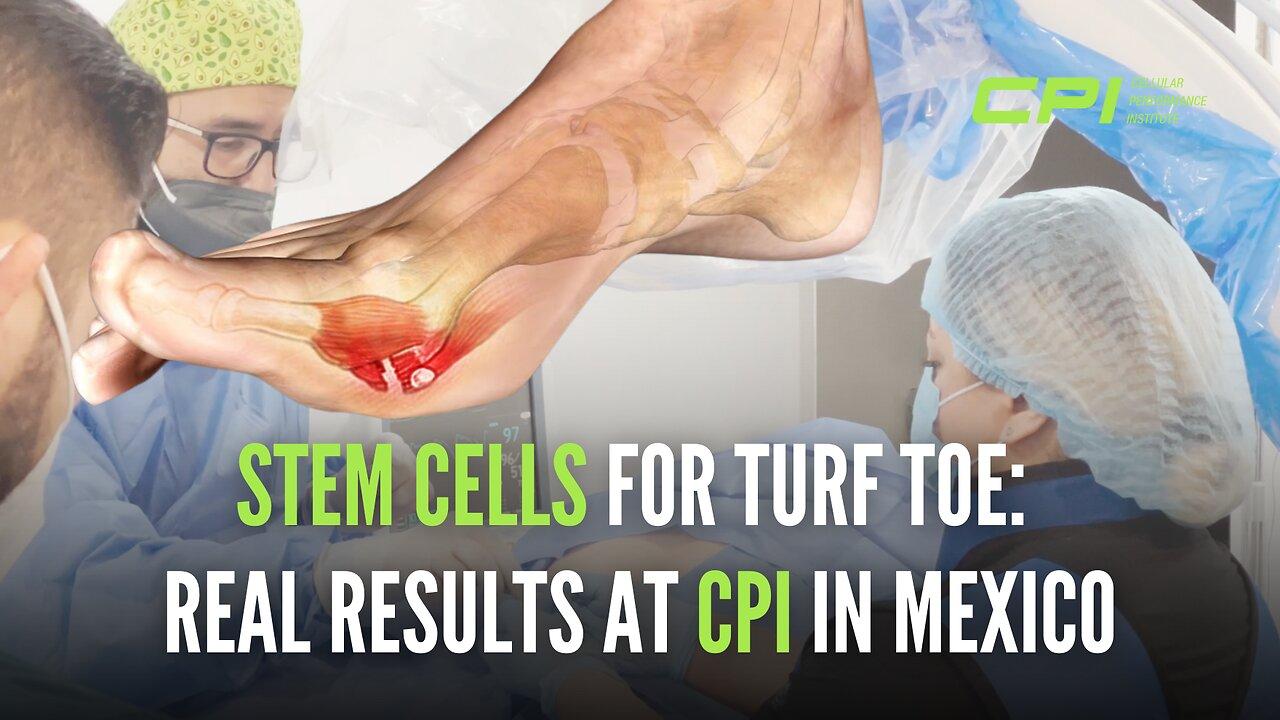 Stem Cells for Turf Toe: Real Results at CPI in Mexico