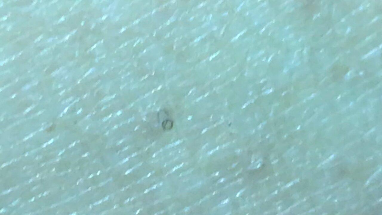 Morgellons or smirt fibres or sth else in our clothes:itching,skin infections- same in covid masks