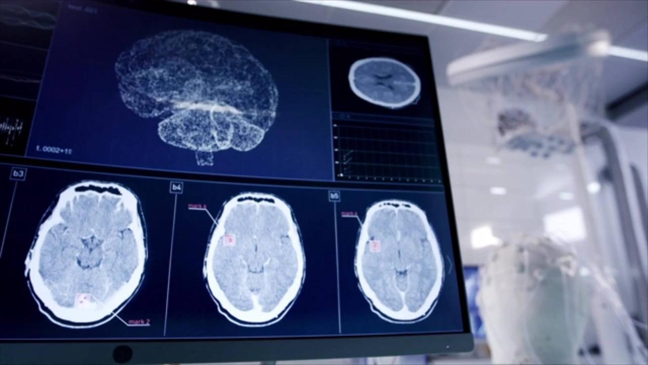 Global Increase of Neurological Disorders 'Very Concerning,' Researchers Say