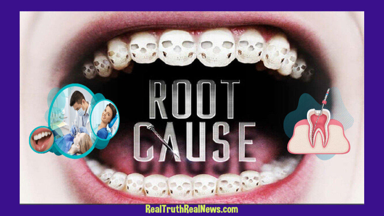 🎬🦷 Documentary: "Root Cause" - Health Issues Caused By Root Canal Procedures Such As Panic Attacks,Chronic Fatig