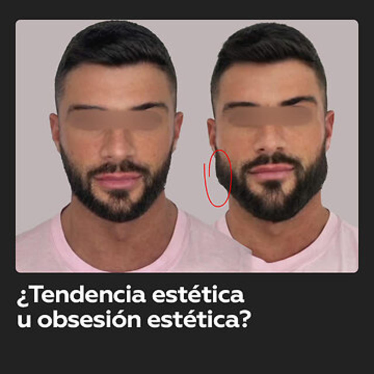 Así se ven los resultados de una de las cirugías estéticas en tendencia