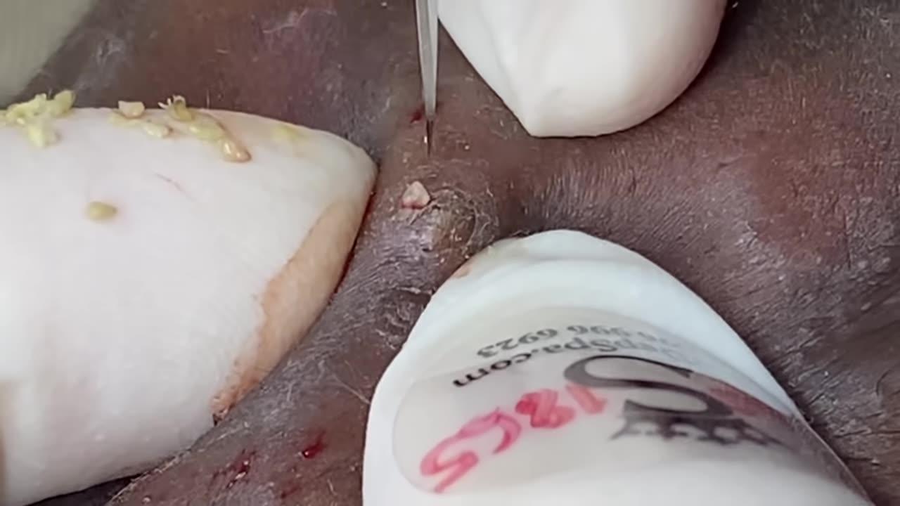 removal extration Blackhead pimple cyst satisfatory #blackhead