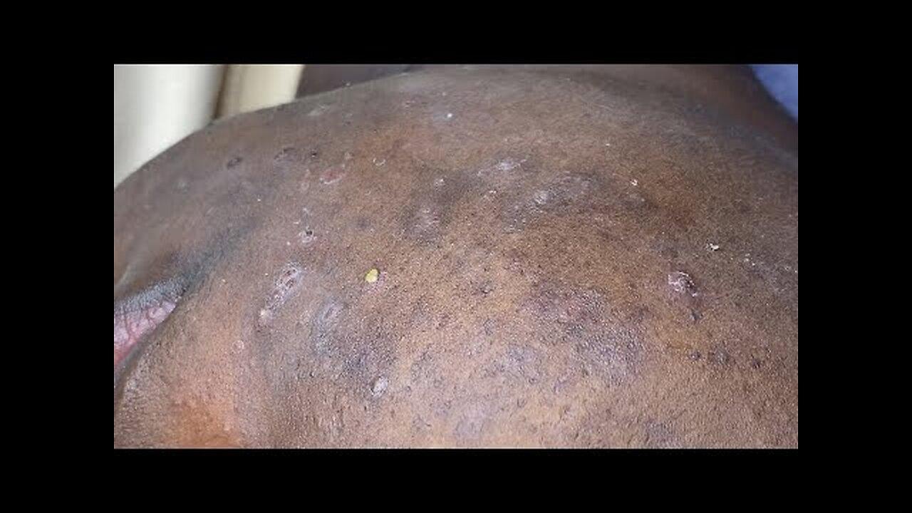 Blackheads Whiteheads Removal Pimple Popper 333